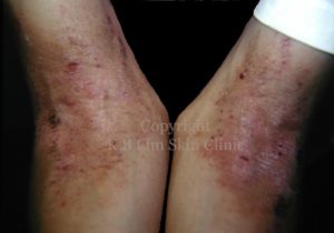 Learn About Atopic Dermatitis - cubital fossa