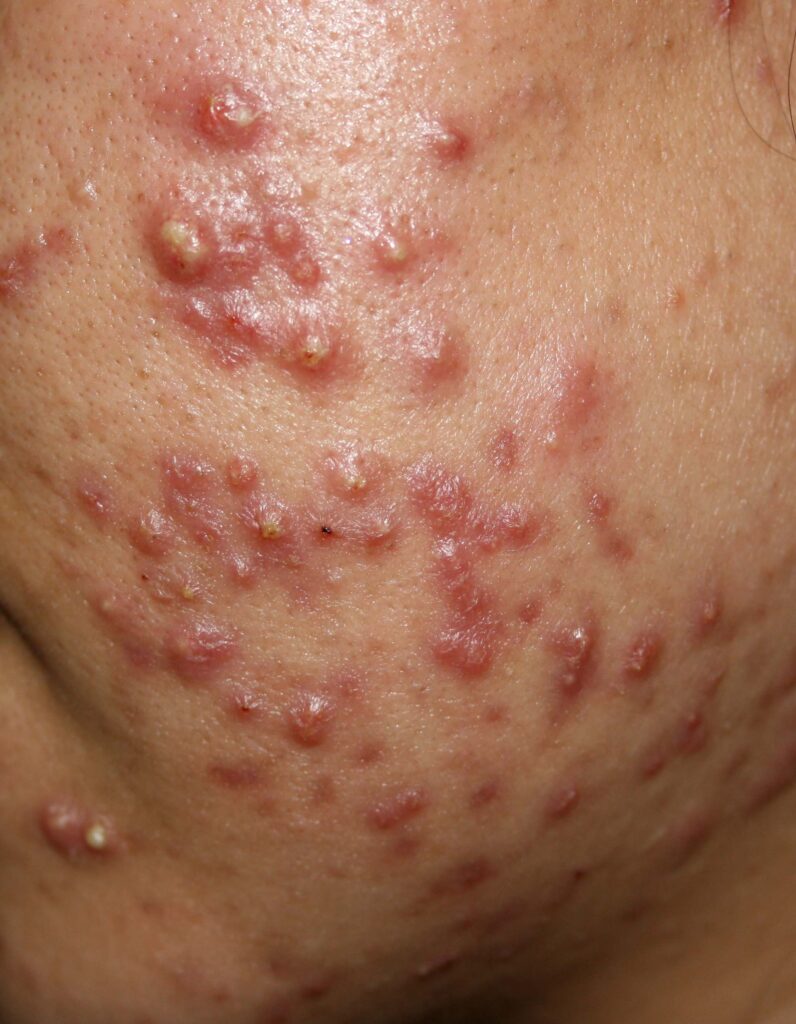 Acne Vulgaris Definition In English